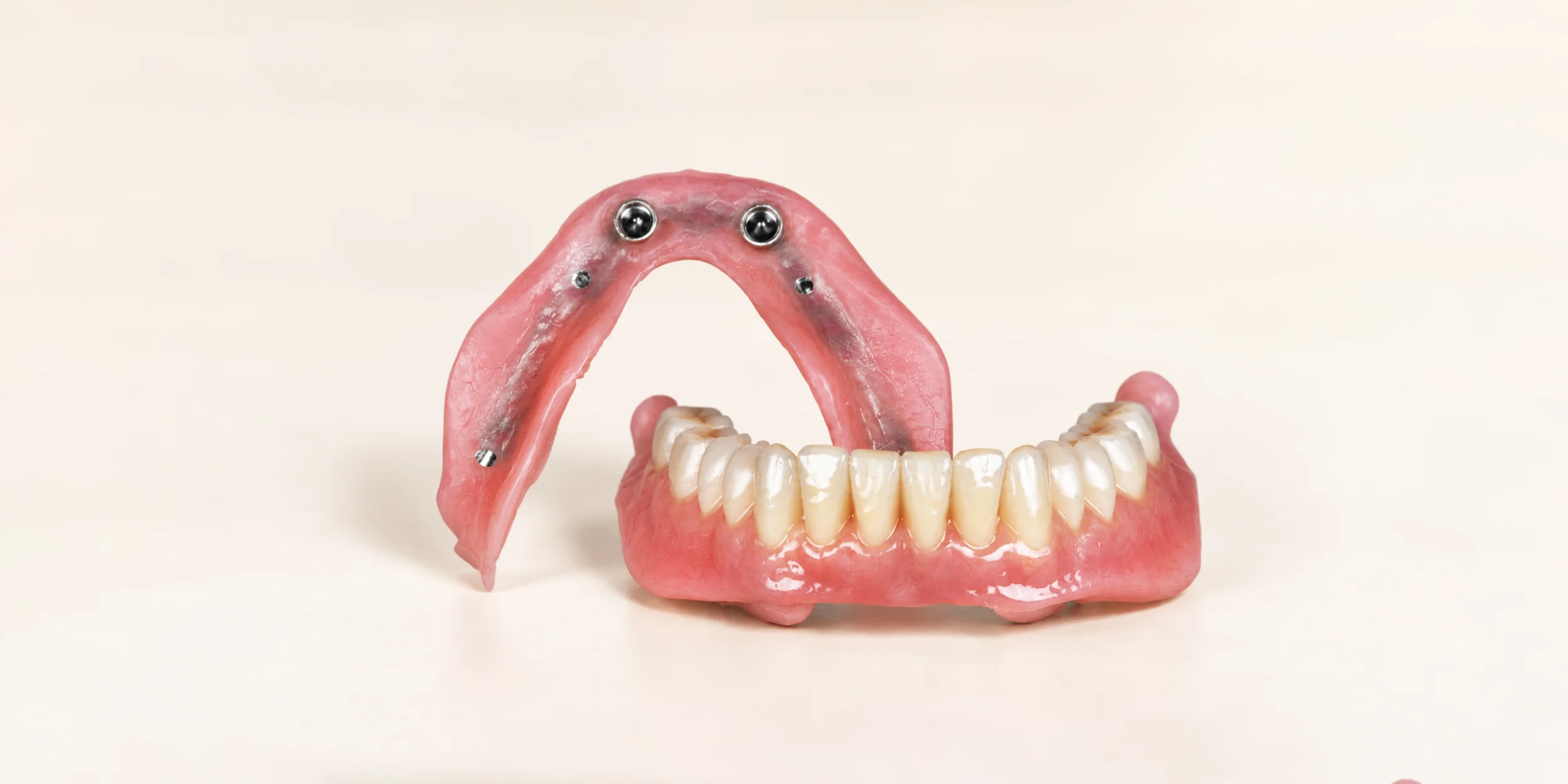 Removable implant-supported overdenture with attachment components displayed on a beige surface.
